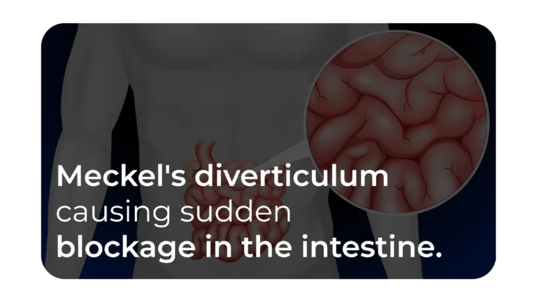 Meckel’s diverticulum causing acute intestinal obstruction: A case report and comprehensive review of the literature