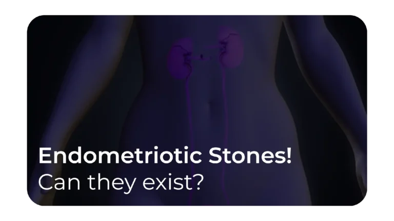 Endometriotic Stones; Can they exist? A case report