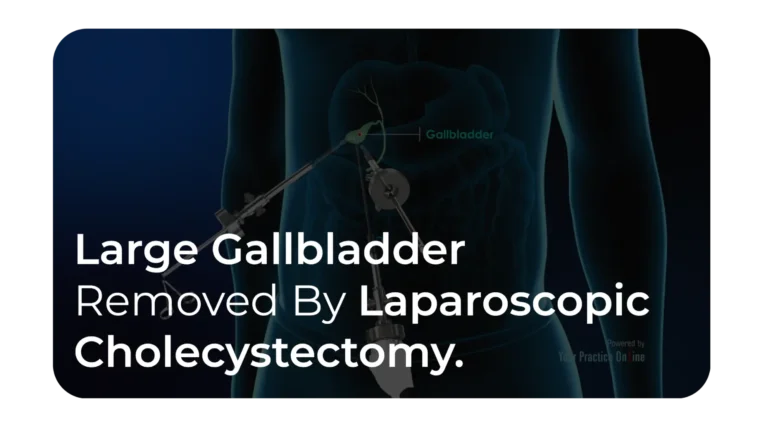 Large Gallbladder Removed By Laparoscopic Cholecystectomy A Case Report​