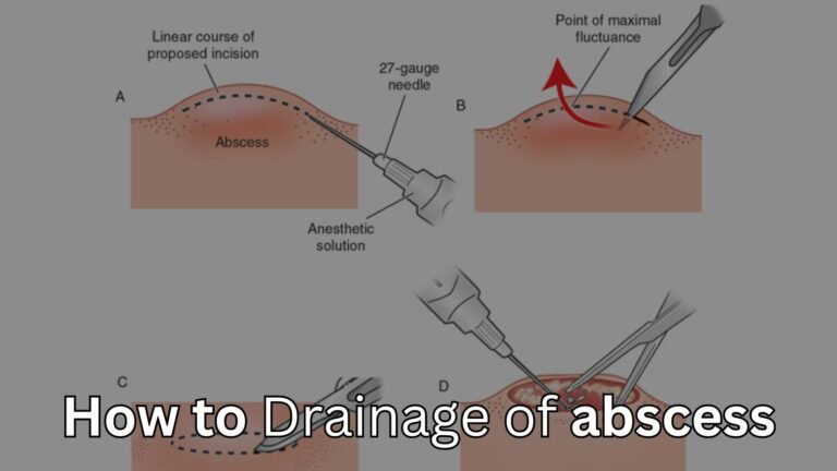 How to Drainage of abscess