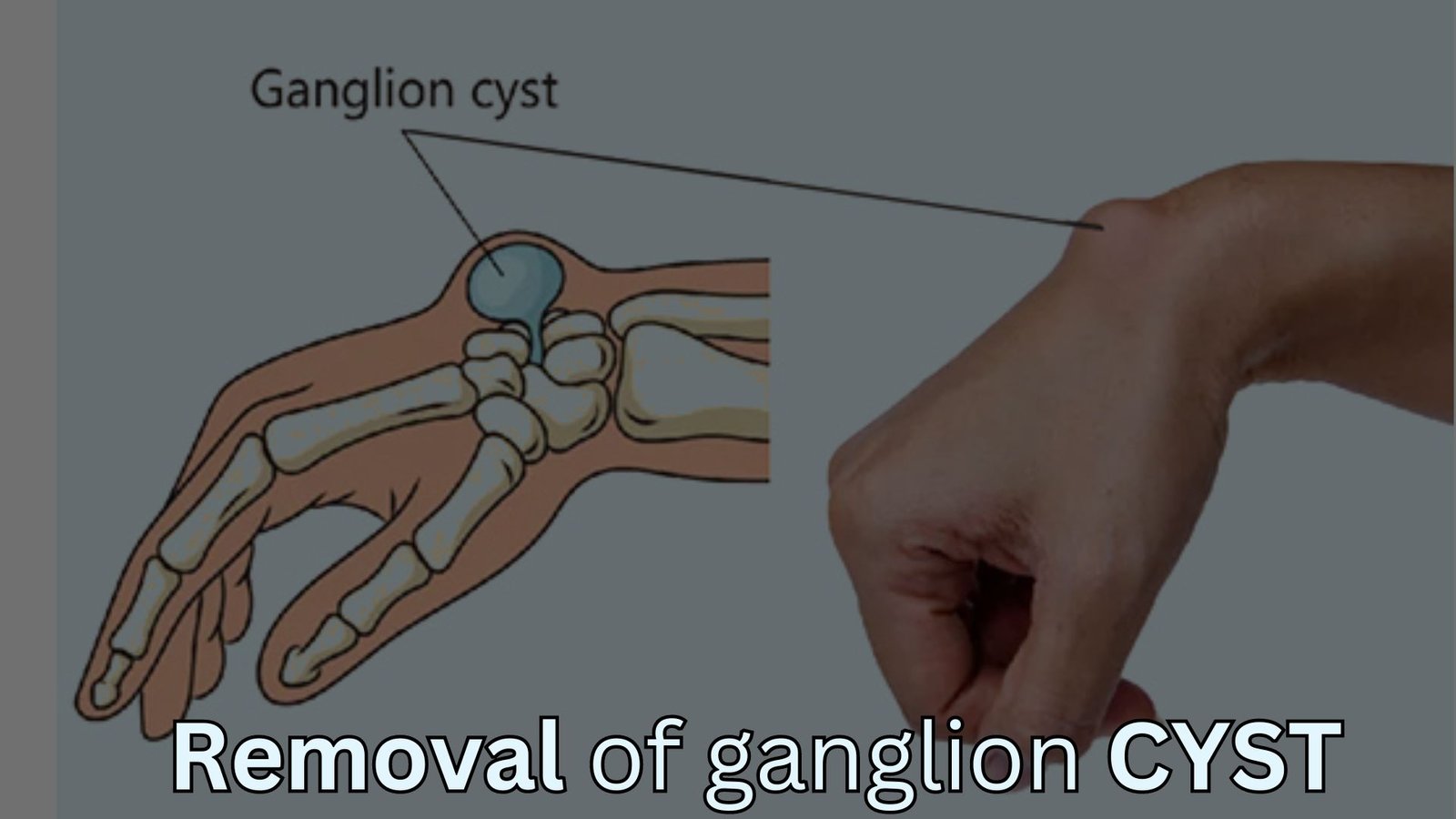 removal of ganglion cyst